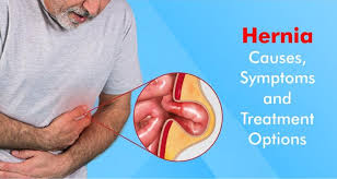What is hernia?